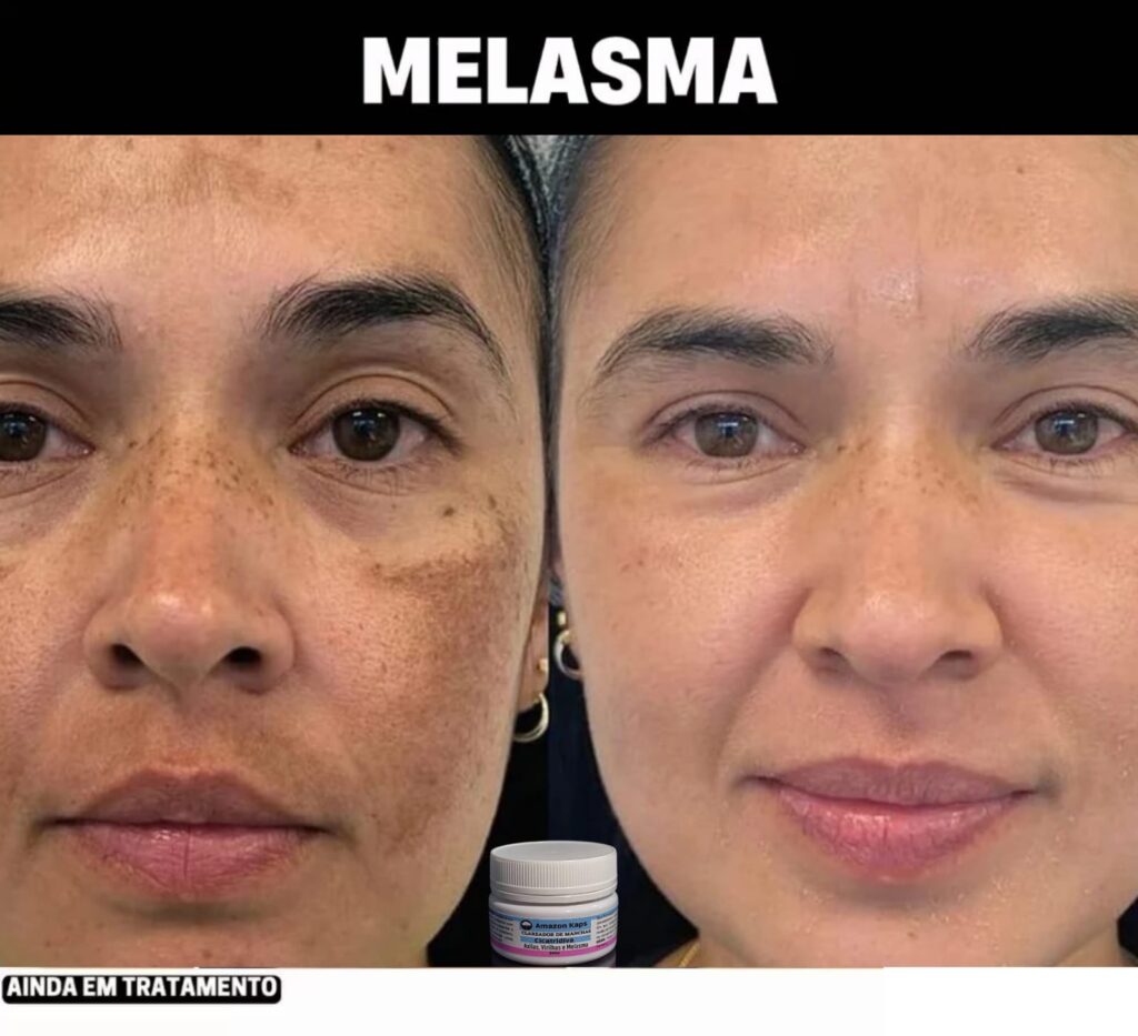 Antes e depois do tratamento com Amazole